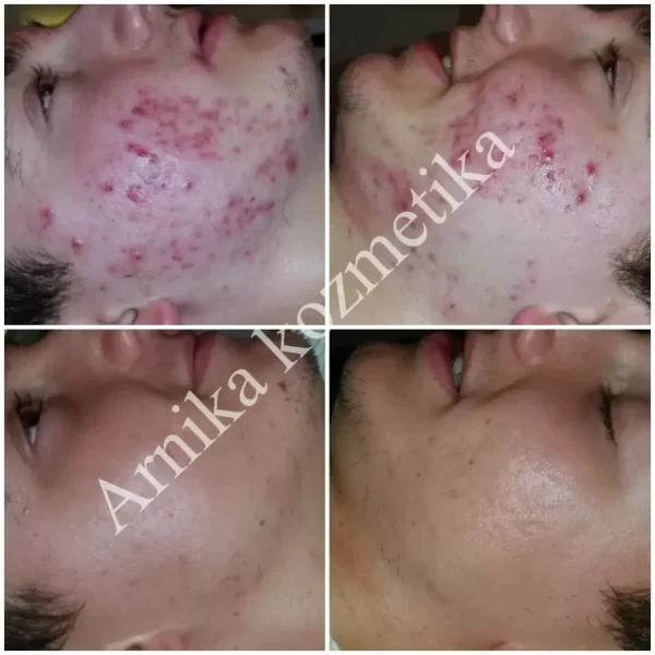 Arnika prije i poslije primjer tretmana kože